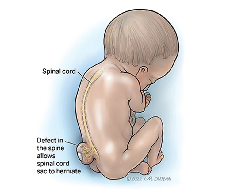 Illustration of spina bifida highlighting the spinal defect that allows the spinal cord sac to herniate.