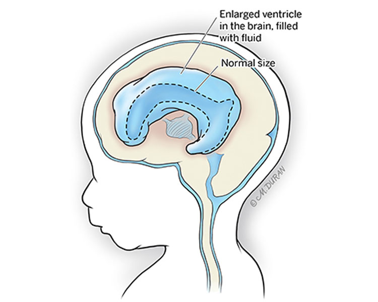 Cross-section illustration of a child's head to demonstrate the enlarged, fluid-filled ventricles in the brain characteristic of ventriculomegaly.