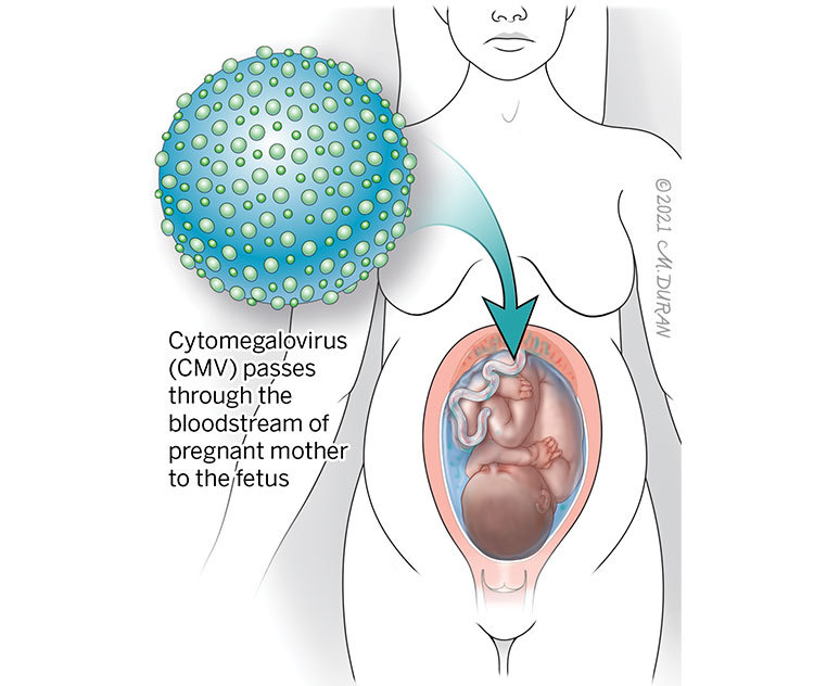 An illustration of a cytomegalovirus particle with an arrow demonstrating how the virus passes from the bloodstream of pregnant mother to the fetus.