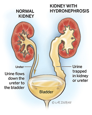Illustration comparing a healthy kidney to a kidney with hydronephrosis, in which urine becomes trapped in the kidney or ureter.