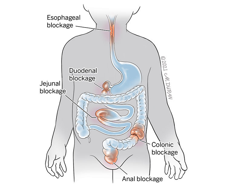 Illustration of different forms of gastrointestinal instruction: a esophageal blockage in the esophagus, a duodenal blockage where the stomach meets the small intestine, a jejunal blockage in the small intestine, a colonic blockage in the large intestine, and an anal blockage in the anus.