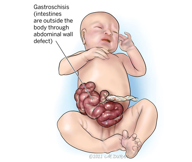 Illustration of gastroschisis, an abdominal wall defect in which intestines are outside the body.