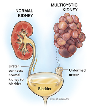 Illustration comparing a healthy kidney to a multicystic kidney, in which there is an unformed ureter and the kidney is encompassed by a cluster of cysts.
