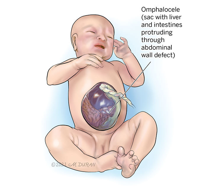 Illustration of an omphalocele, a sac with liver and intestines protruding through an abdominal wall defect.