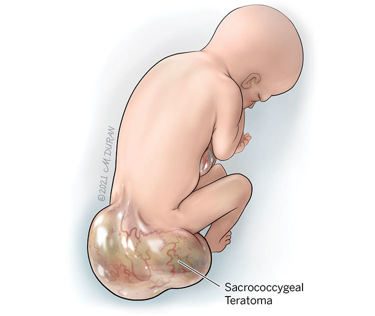 Illustration of a sacrococcygeal teratoma, a growth on the tailbone of a fetus.